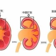 左肾集合系统分离怎么回事,孕晚期胎儿左肾肾盂分离什么意思