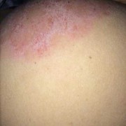 屁股湿疹是怎么回事,为什么孕期屁股长湿疹呢