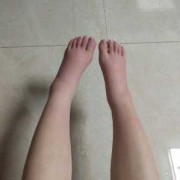 孕期腿手肿（孕期腿肿手肿）