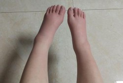 孕期腿手肿（孕期腿肿手肿）