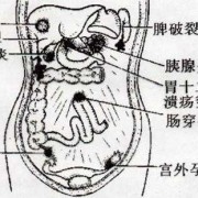 孕期腹膜炎（孕期腹膜炎）