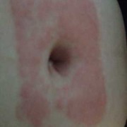 孕期肚脐痒（孕期肚脐痒怎么办）