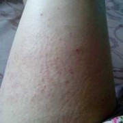 孕期腿痒是怎么回事啊（孕期下面痒什么原因）