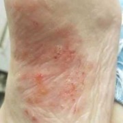 孕期脚气犯了脚趾缝痒怎么办（请问孕妇怀孕八个月的时候脚趾缝里面痒怎么办啊？是不是得了脚气）