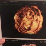 怀孕16周宝宝总在一侧动，正常吗,16周男胎儿特点图片