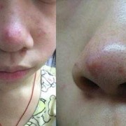 孕期鼻子长痘（孕期鼻子长痘痘是什么原因）