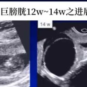 胎儿膀胱未显示是怎么事,胎儿膀胱大小正常值