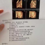 四维胎儿趴着怎么办（做四维彩超孩子趴着，看不到脸，怎么办）