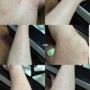 孕妇得湿疹怎么治,孕妇孕期长湿疹怎么办啊