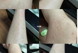 孕妇得湿疹怎么治,孕妇孕期长湿疹怎么办啊