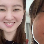 备孕期拔牙（备孕期拔牙有影响吗）