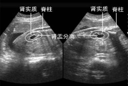 双胎儿图（胎儿双肾盂未见分离是什么意思）