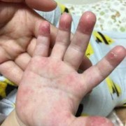 一岁三个月宝宝十个手指起皮是怎么回事,胎儿缺手是什么原因