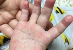 一岁三个月宝宝十个手指起皮是怎么回事,胎儿缺手是什么原因