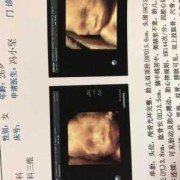 长鼻子男孩短片解析,胎儿三维鼻子好大