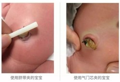 胎儿出生后脐带怎么办（胎儿出生后脐带怎么处理）