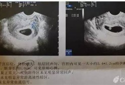 怀孕四十天怀男孩孕囊是什么样子的啊,男胎儿阴囊什么时候形成