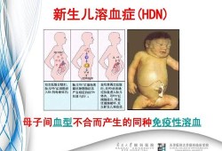 胎儿融血（abo溶血对胎儿发育有影响吗）