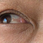 胎儿没眼球（宝宝白眼球里面有点发灰，是什么原因）