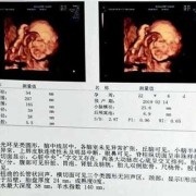 孕期检查数据（四维彩超hc是什么意思呢？是看什么的呢）