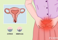 怀孕后宫颈息肉出血怎么办,孕期宫颈息肉反复出血怎么办