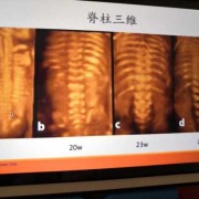 胎儿脊柱偏（胎儿脊柱位于母体右侧是什么意思）