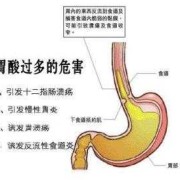 孕期胃酸过多（孕期胃酸过多是什么原因造成的）