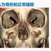 鼻骨短是什么意思,24周胎儿鼻骨长标准对照表