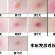 水痘对胎儿的影响案例（水痘对胎儿的影响案例）