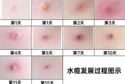 水痘对胎儿的影响案例（水痘对胎儿的影响案例）