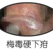 梅毒会传染给胎儿吗（孕妇梅毒会传染给胎儿吗）