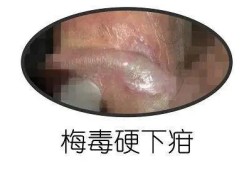 梅毒会传染给胎儿吗（孕妇梅毒会传染给胎儿吗）