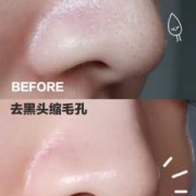 孕期如何去黑头（孕期如何去黑头）