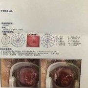 孕期宫颈活检（孕期宫颈活检有危险吗）