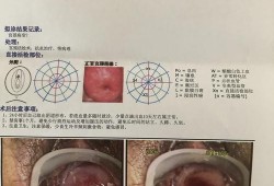 孕期宫颈活检（孕期宫颈活检有危险吗）