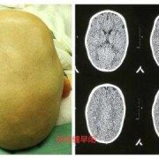 胎儿头扁（胎儿头扁长属于畸形吗）