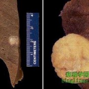 胎儿错构瘤（胎儿错构瘤严重吗）