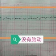 做胎心监护对胎儿有影响吗（天天做胎心监护对胎儿有影响吗）