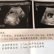八个月胎儿没有胎心是什么原因造成的,怎样让胎儿没有胎心胎芽