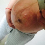 孕期妊娠纹图片（孕期妊娠纹图片大全）