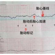 胎心监测时宝宝不动怎么办,胎心监护胎儿不动怎么办吸氧也不动