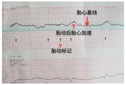 胎心监测时宝宝不动怎么办,胎心监护胎儿不动怎么办吸氧也不动