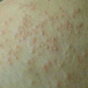 孕期湿疹（孕期湿疹止痒最有效的方法）