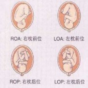 roa是什么,右骶横位胎儿图片大全