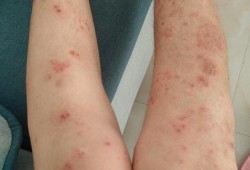 孕期荨麻疹怎样止痒（荨麻疹迅速止痒办法有哪些）
