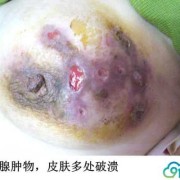 孕期乳腺炎（孕期乳腺炎）