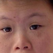 宝宝眼距宽是怎么回事,胎儿眼距正常值范围是多少