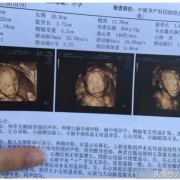 四维彩超官宣文案,四维彩超胎儿照片分得出男女吗?