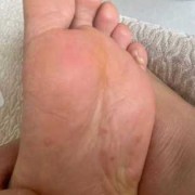 孕期脚底长水泡很痒（孕期脚底长水泡很痒,会影响孩子吗）