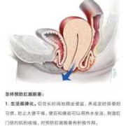 孕妇便秘脱肛怎么办,孕期肛脱怎么办